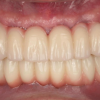 Full ARCH IMPLANT RESTORATION 