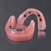 OVER DENTURE