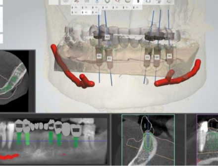 Implant Planning - Surgical Guide 