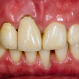 4 Unit Bridge(Before)