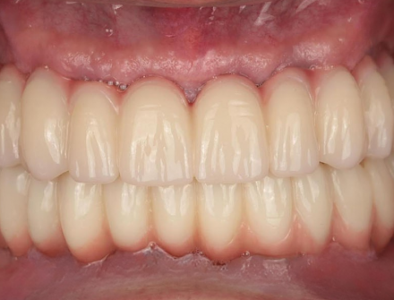 Full ARCH IMPLANT RESTORATION 
