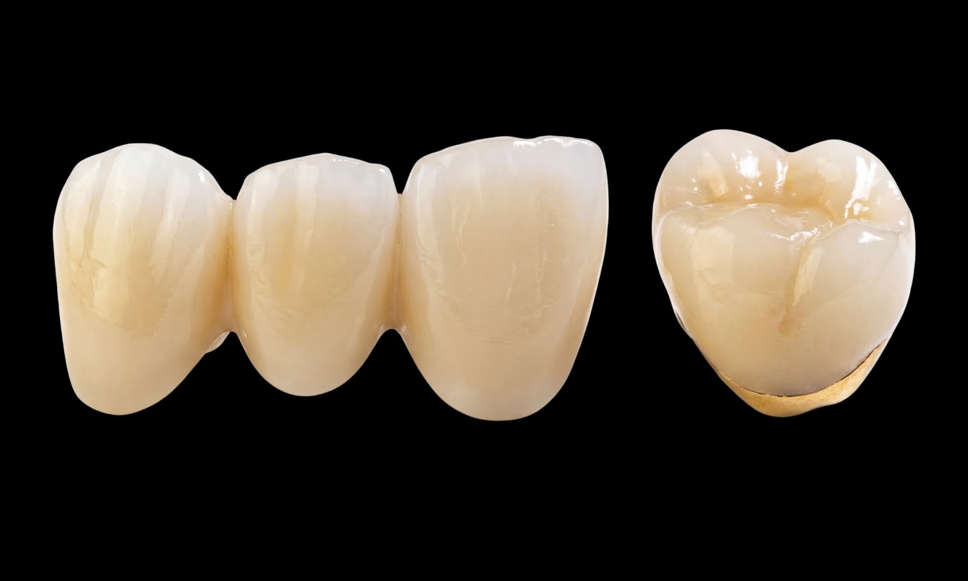 PFM (Porcelain-Fused-to-Metal) - ATTACHMENTS